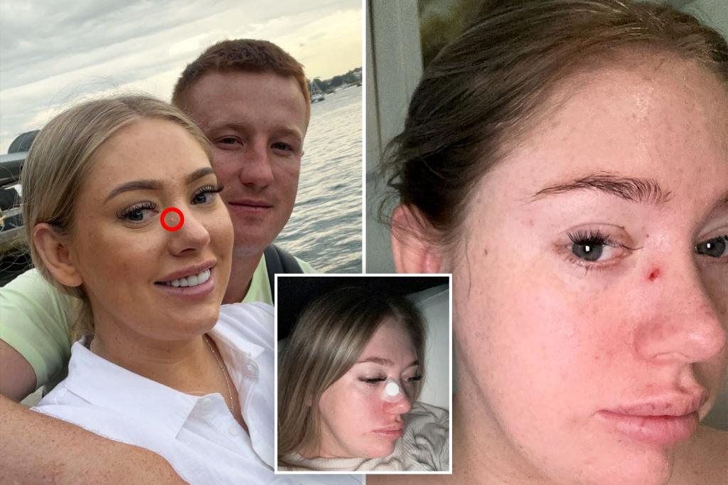 New mum's 'clogged pore' turns out to be skin cancer: 'You never think this will happen to you'